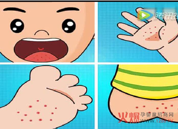 手足口病又来了,99%的父母忽视了预防!