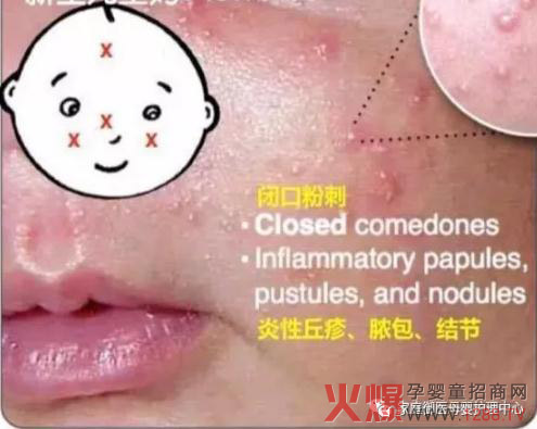 宝宝脸上长小红疙瘩?湿疹OR痤疮?可用家庭御