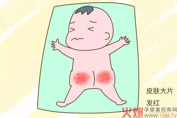宝宝反复红臀,红屁股 宜护适教你这样做,赶走屁屁不适很简单!