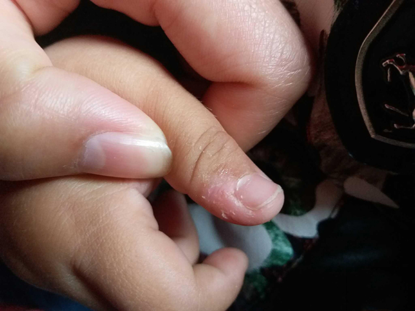 寶寶手脫皮怎么辦？試試七季山茶柔嫩護(hù)手霜呀4.jpg